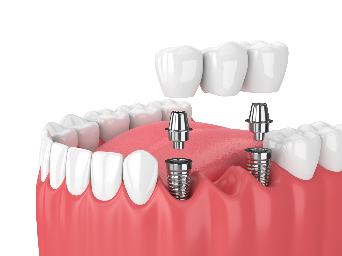 Implants
